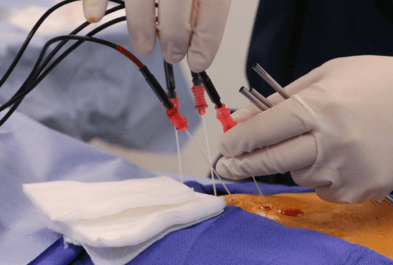 radiofrequency ablation treatment
